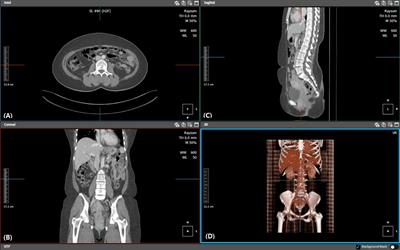 Influence of sarcopenia on postoperative complications in patients undergoing autologous microsurgical breast reconstruction: an inverse probability of treatment weighting analysis